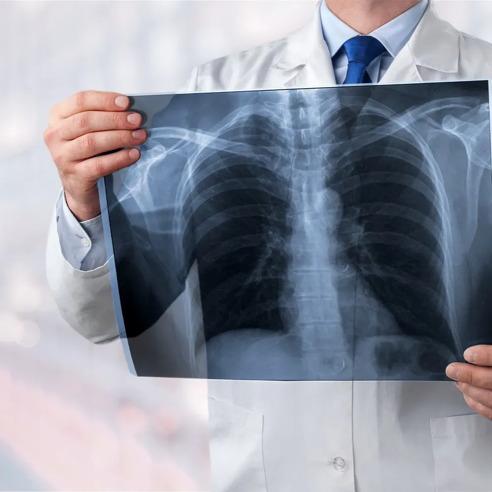 Lung Cancer Screening